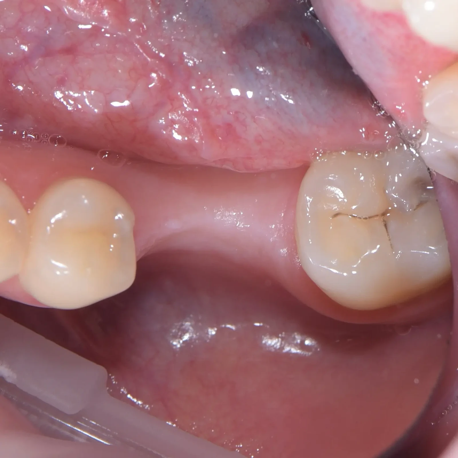 Posterior tooth replacement with an implant