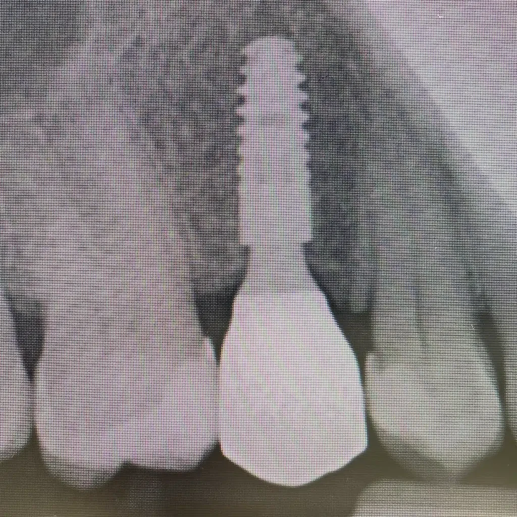 Replacement of missing second premolar with an implant