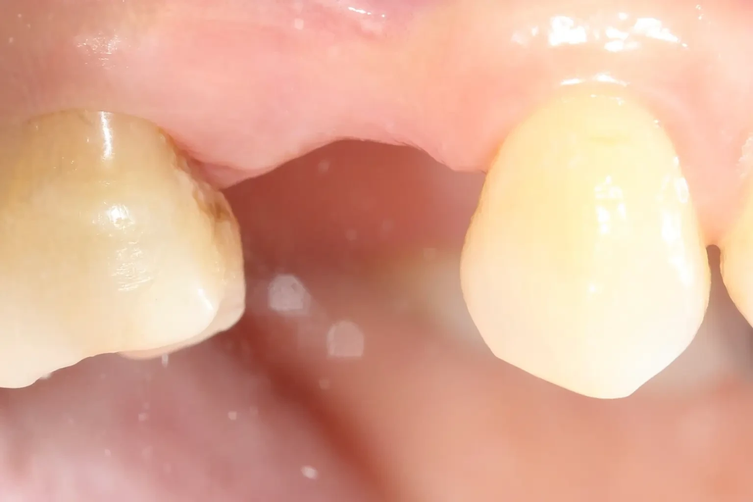 All-ceramic crown on an implant