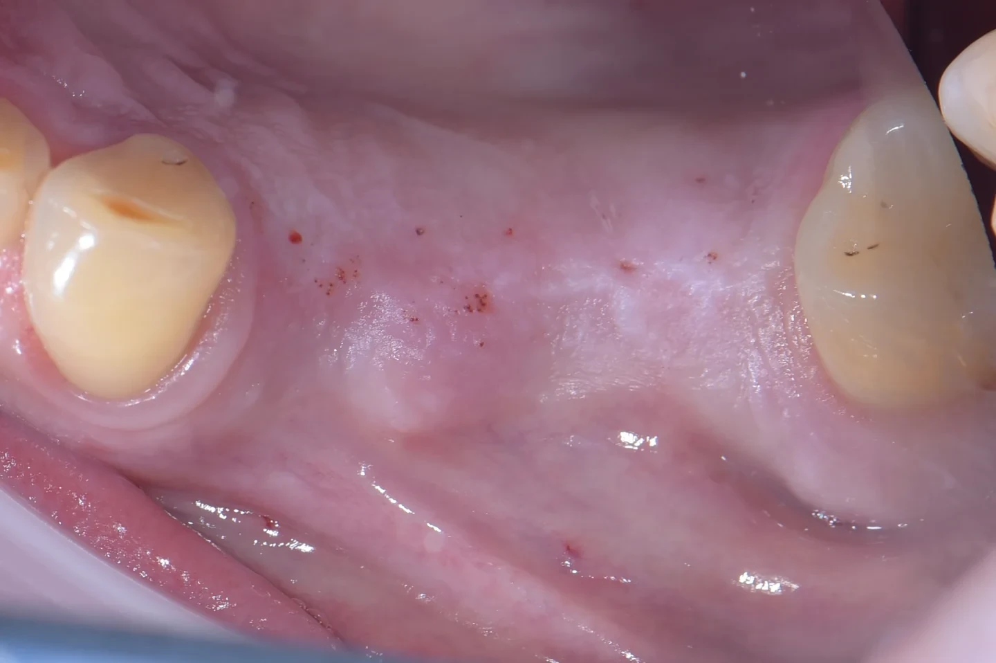 Sinus lift and implant reconstruction