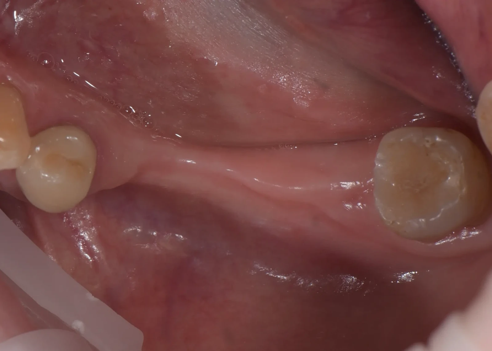 Bone augmentation and implant reconstruction