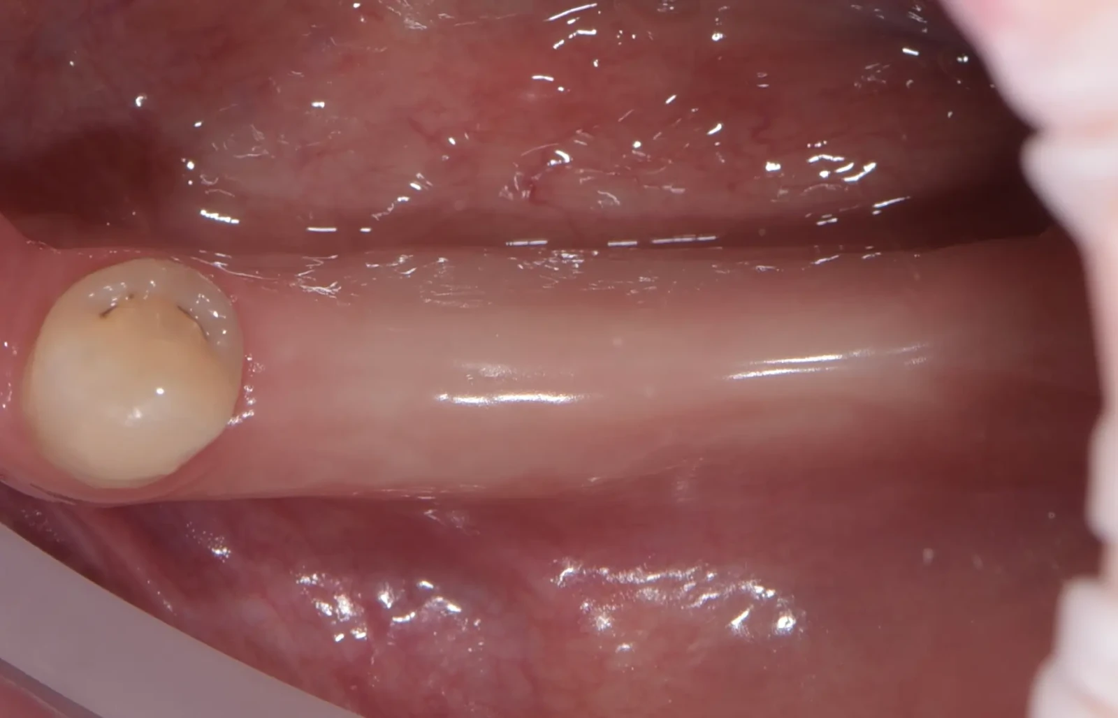 Comprehensive implant reconstruction of the posterior segment