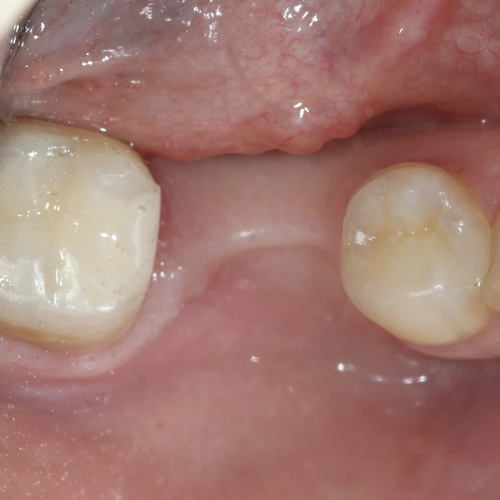 Implantation and crown in the posterior segment