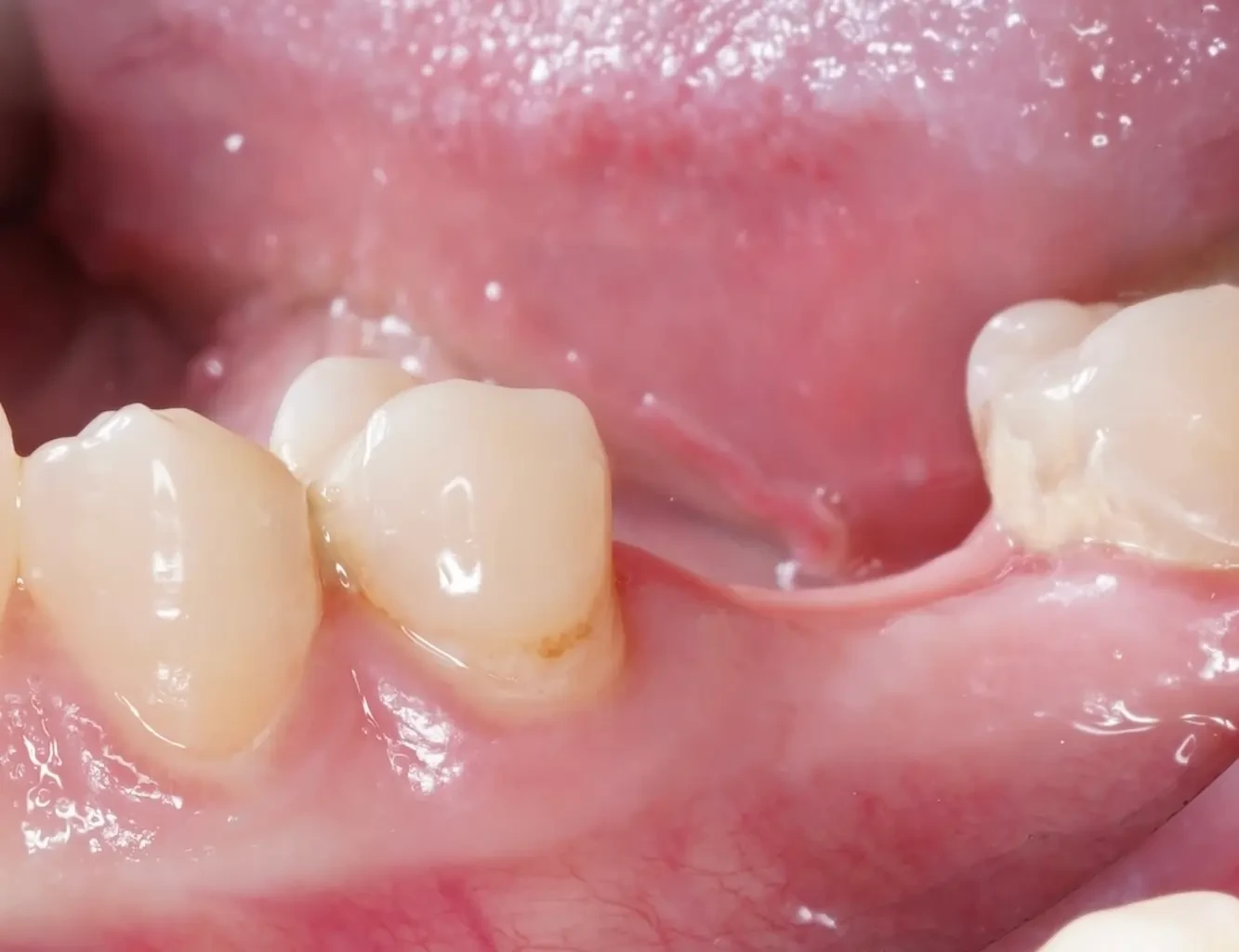 Implant with gum augmentation and zirconium crown